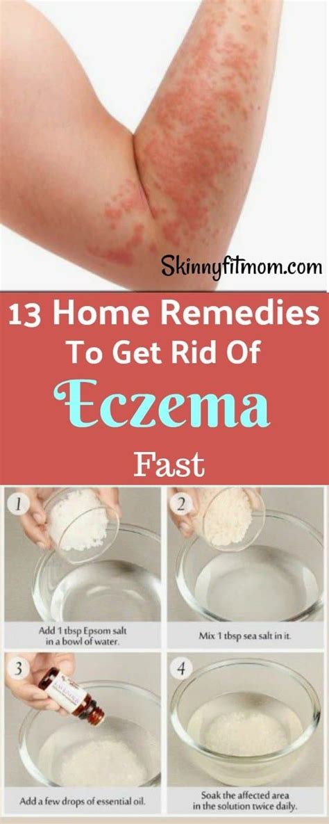 how to get rid of eczema fast.